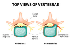 infographic of top view of vertebrae - back injury attorney near you in Queens
