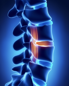 Spinal cord injury lawyer near you in Queens NYC